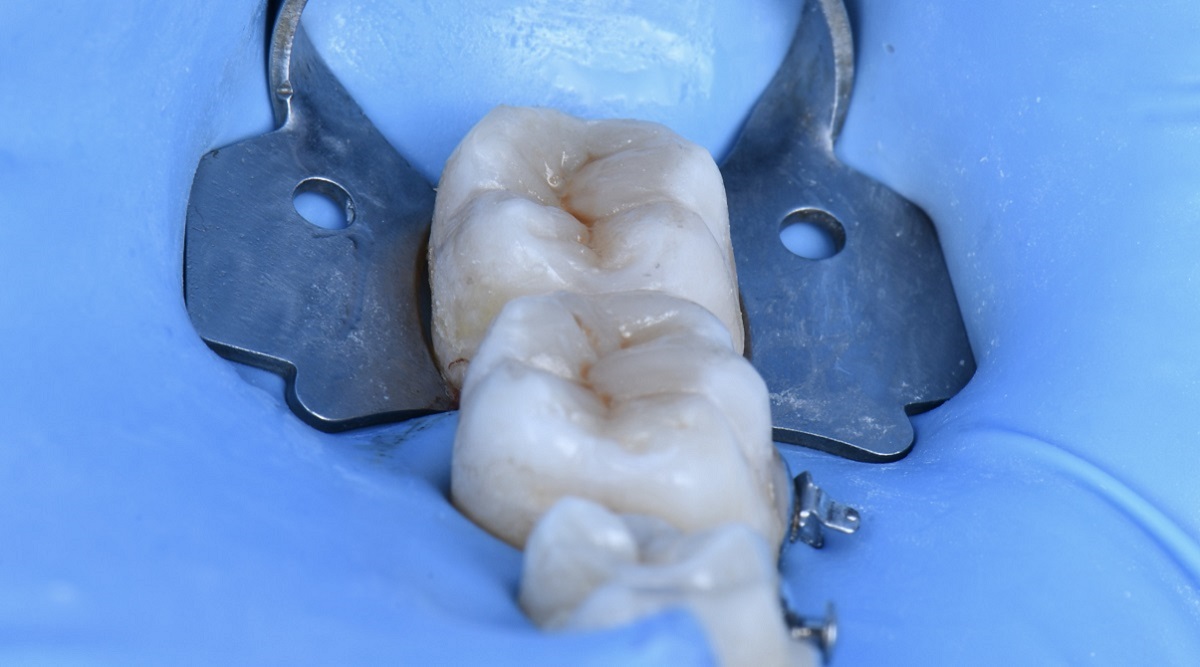 Epsilon Dental Clinic, estetik diş hekimliği, mikroskop destekli diş hekimliği, restoratif diş hekimliği, endodonti, protetik tedaviler, ortodontik tedaviler, cerrahi diş tedavileri, lamine diş, yaprak lamine, çene eklemi tedavileri, çocuk diş hekimliği, periodontal tedaviler, kompozit dolgu, diş beyazlatma, implant üstü protez, porselen lamine, kanal tedavisi, inlay onlay overlay, gece plağı, oklüzal splint, ICON rezin infiltrasyon, adeziv diş hekimliği