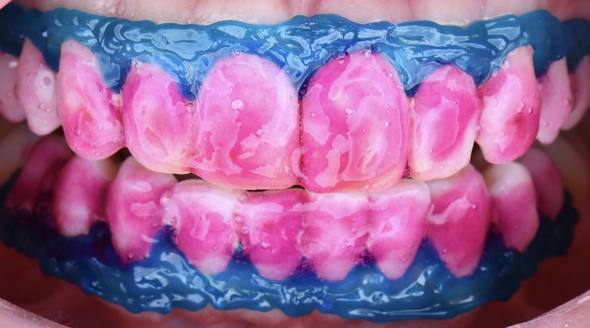 Epsilon Dental Clinic, estetik diş hekimliği, mikroskop destekli diş hekimliği, restoratif diş hekimliği, endodonti, protetik tedaviler, ortodontik tedaviler, cerrahi diş tedavileri, lamine diş, yaprak lamine, çene eklemi tedavileri, çocuk diş hekimliği, periodontal tedaviler, kompozit dolgu, diş beyazlatma, implant üstü protez, porselen lamine, kanal tedavisi, inlay onlay overlay, gece plağı, oklüzal splint, ICON rezin infiltrasyon, adeziv diş hekimliği