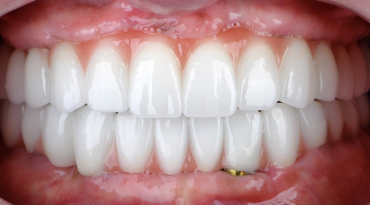 Epsilon Dental Clinic, estetik diş hekimliği, mikroskop destekli diş hekimliği, restoratif diş hekimliği, endodonti, protetik tedaviler, ortodontik tedaviler, cerrahi diş tedavileri, lamine diş, yaprak lamine, çene eklemi tedavileri, çocuk diş hekimliği, periodontal tedaviler, kompozit dolgu, diş beyazlatma, implant üstü protez, porselen lamine, kanal tedavisi, inlay onlay overlay, gece plağı, oklüzal splint, ICON rezin infiltrasyon, adeziv diş hekimliği