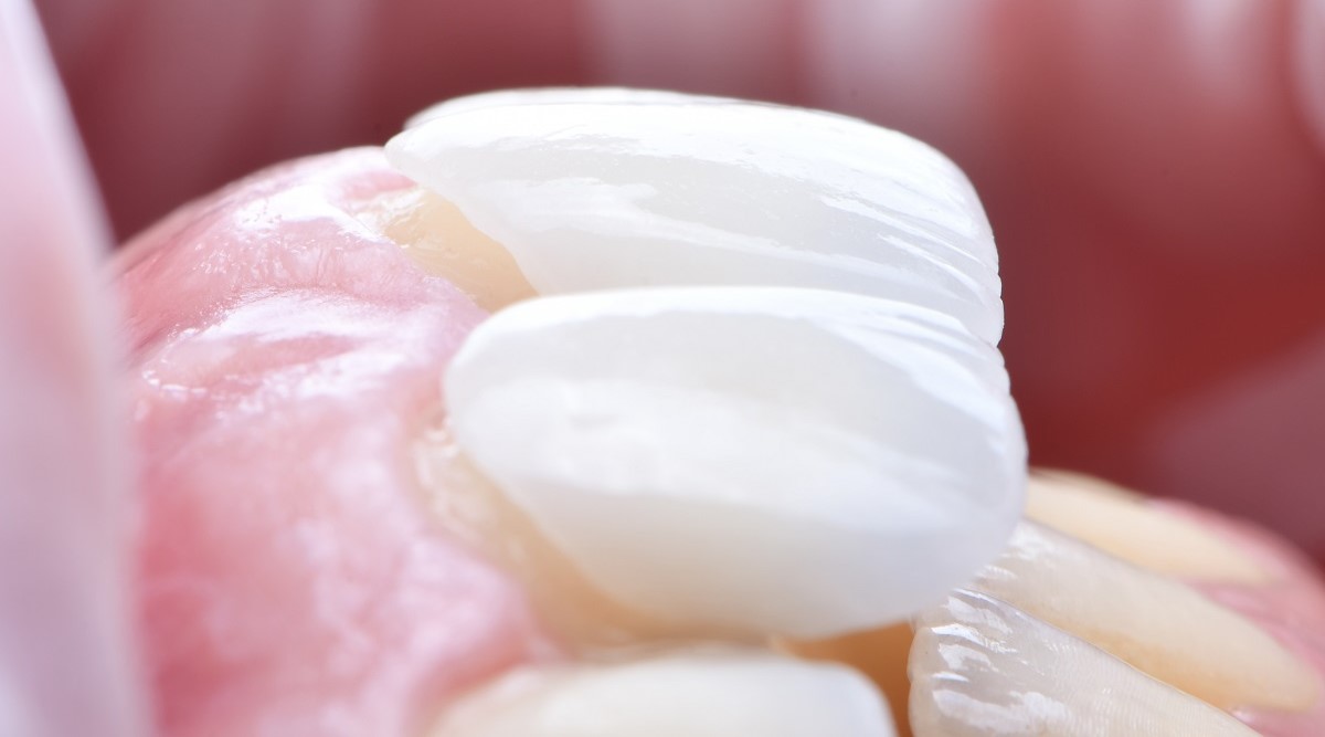 Epsilon Dental Clinic, estetik diş hekimliği, mikroskop destekli diş hekimliği, restoratif diş hekimliği, endodonti, protetik tedaviler, ortodontik tedaviler, cerrahi diş tedavileri, lamine diş, yaprak lamine, çene eklemi tedavileri, çocuk diş hekimliği, periodontal tedaviler, kompozit dolgu, diş beyazlatma, implant üstü protez, porselen lamine, kanal tedavisi, inlay onlay overlay, gece plağı, oklüzal splint, ICON rezin infiltrasyon, adeziv diş hekimliği