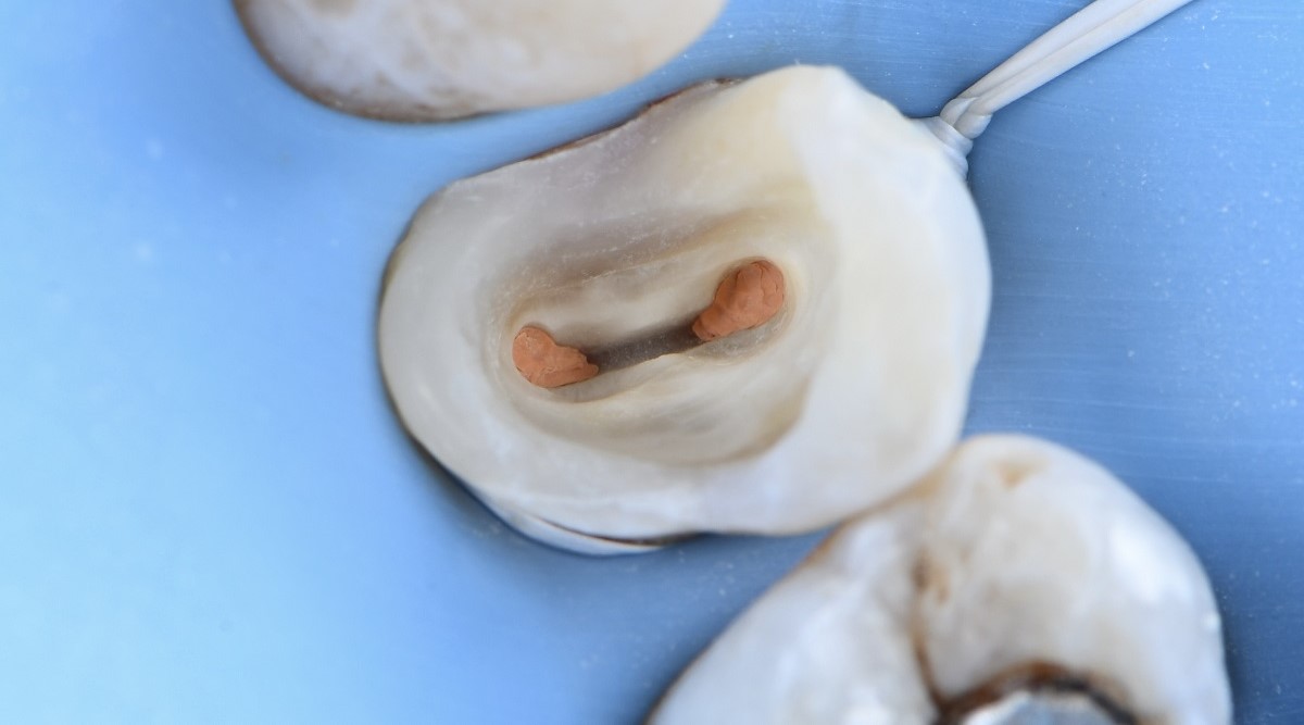 Epsilon Dental Clinic, estetik diş hekimliği, mikroskop destekli diş hekimliği, restoratif diş hekimliği, endodonti, protetik tedaviler, ortodontik tedaviler, cerrahi diş tedavileri, lamine diş, yaprak lamine, çene eklemi tedavileri, çocuk diş hekimliği, periodontal tedaviler, kompozit dolgu, diş beyazlatma, implant üstü protez, porselen lamine, kanal tedavisi, inlay onlay overlay, gece plağı, oklüzal splint, ICON rezin infiltrasyon, adeziv diş hekimliği