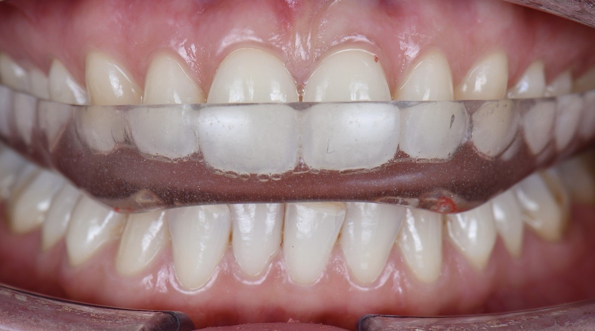 Epsilon Dental Clinic, estetik diş hekimliği, mikroskop destekli diş hekimliği, restoratif diş hekimliği, endodonti, protetik tedaviler, ortodontik tedaviler, cerrahi diş tedavileri, lamine diş, yaprak lamine, çene eklemi tedavileri, çocuk diş hekimliği, periodontal tedaviler, kompozit dolgu, diş beyazlatma, implant üstü protez, porselen lamine, kanal tedavisi, inlay onlay overlay, gece plağı, oklüzal splint, ICON rezin infiltrasyon, adeziv diş hekimliği