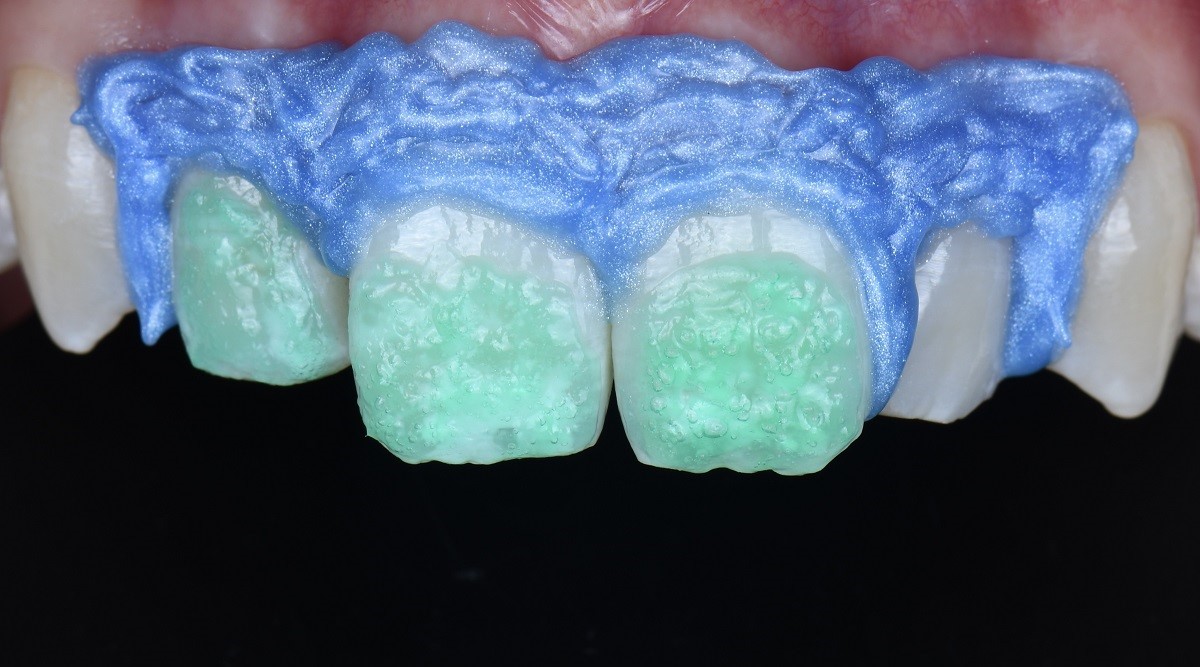 Epsilon Dental Clinic, estetik diş hekimliği, mikroskop destekli diş hekimliği, restoratif diş hekimliği, endodonti, protetik tedaviler, ortodontik tedaviler, cerrahi diş tedavileri, lamine diş, yaprak lamine, çene eklemi tedavileri, çocuk diş hekimliği, periodontal tedaviler, kompozit dolgu, diş beyazlatma, implant üstü protez, porselen lamine, kanal tedavisi, inlay onlay overlay, gece plağı, oklüzal splint, ICON rezin infiltrasyon, adeziv diş hekimliği