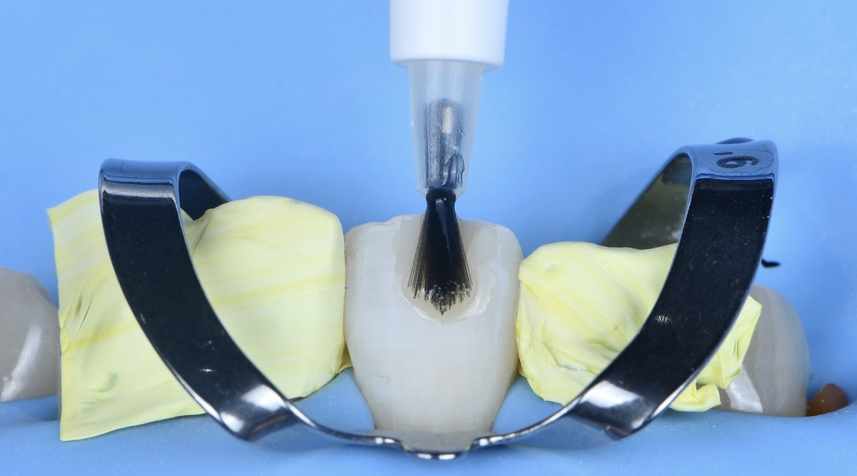Epsilon Dental Clinic, estetik diş hekimliği, mikroskop destekli diş hekimliği, restoratif diş hekimliği, endodonti, protetik tedaviler, ortodontik tedaviler, cerrahi diş tedavileri, lamine diş, yaprak lamine, çene eklemi tedavileri, çocuk diş hekimliği, periodontal tedaviler, kompozit dolgu, diş beyazlatma, implant üstü protez, porselen lamine, kanal tedavisi, inlay onlay overlay, gece plağı, oklüzal splint, ICON rezin infiltrasyon, adeziv diş hekimliği
